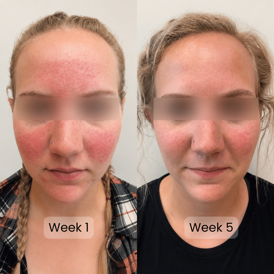 Less random flares and healthy skin